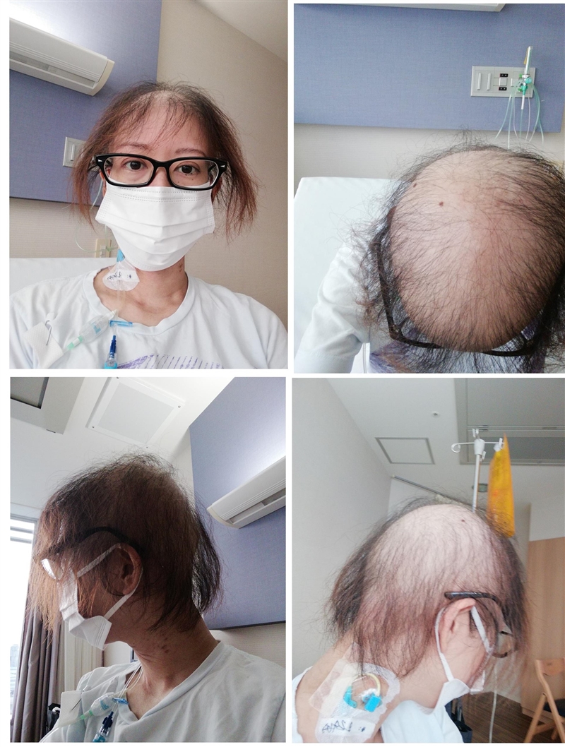 急性リンパ性白血病 クローン病 闘病日記8 臍帯血移植